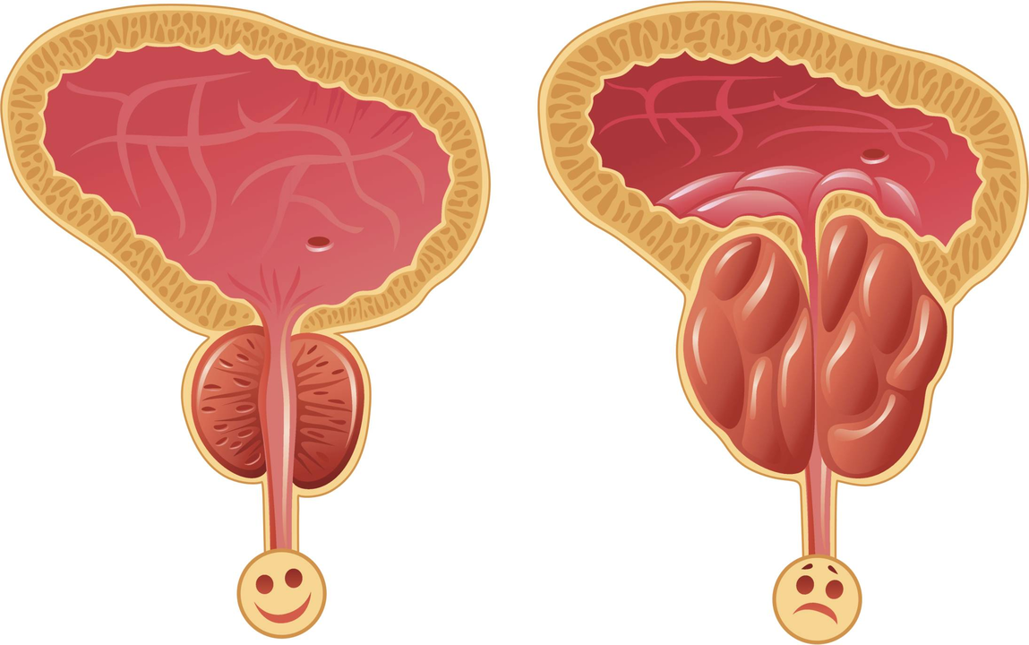 Wie man das Vorhandensein von Prostatitis bestimmt