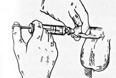 Instillationen bei Prostatitis