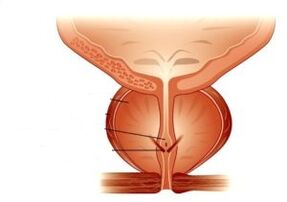 Prostatitis und ihre Behandlung mit Medikamenten