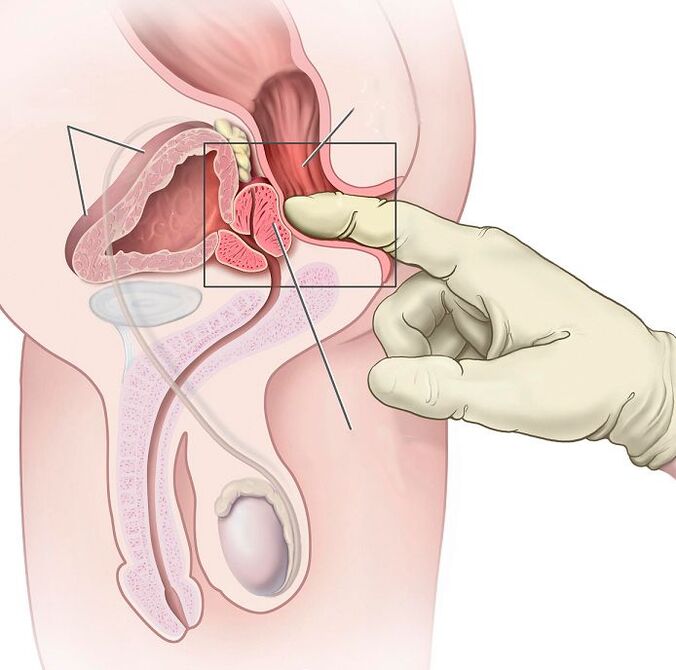 Prostatamassage zur Behandlung von Prostatitis.