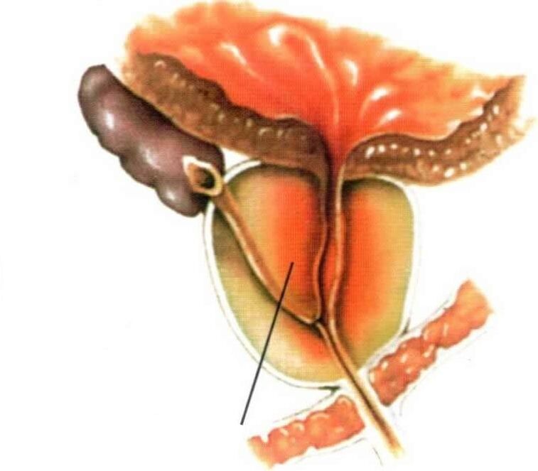 Entzündung des Prostatagewebes bei chronischer Prostatitis.